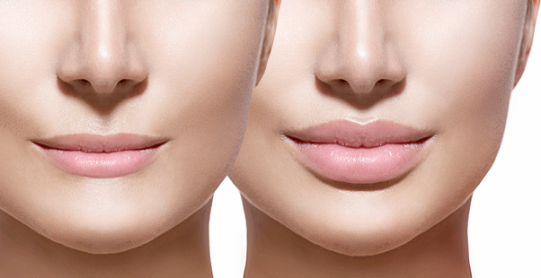 fillers consult cta