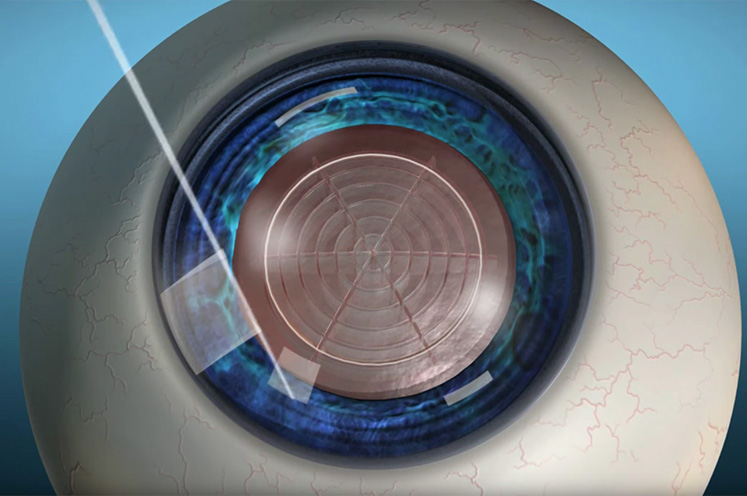 Laser Cataract Surgery | Eye Care | Henry Ford Health - Detroit, MI Laser Cataract Surgery | Eye Care | Henry Ford Health - Detroit, MI
