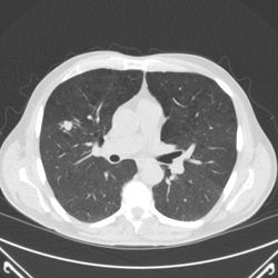 Lung cancer screening image