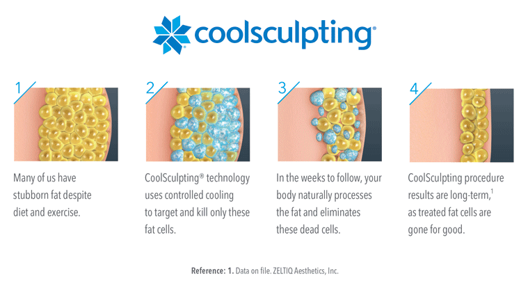 Coolsculpting illustrated process