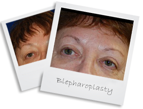 blepharoplasty1