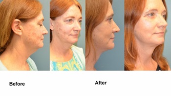 deeb facelift 1