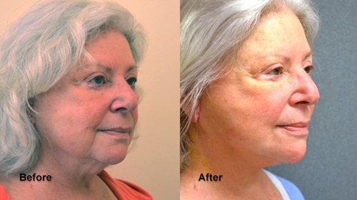 deeb facelift 2