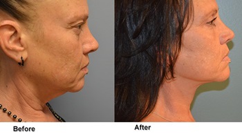 deeb facelift 3