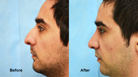 deeb rhinoplasty 4