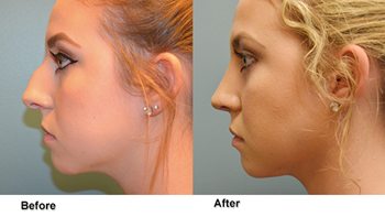 deeb rhinoplasty 7