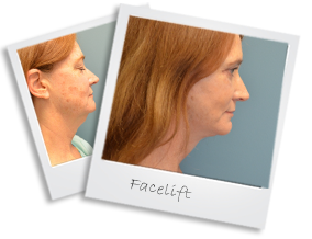 facelift823