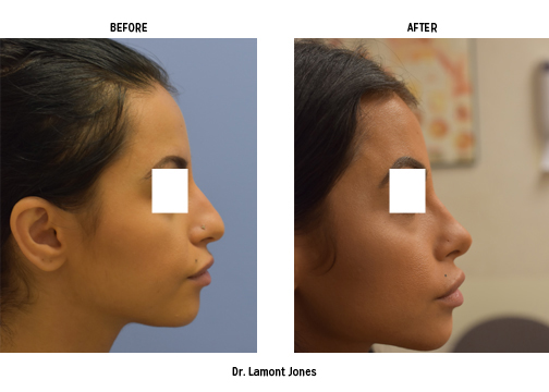 Dr Jones Before and After Patient 2