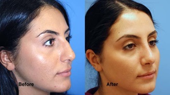jones rhinoplasty 2