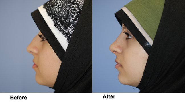 jones rhinoplasty 3
