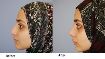 jones rhinoplasty 4