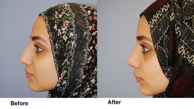 jones rhinoplasty 4