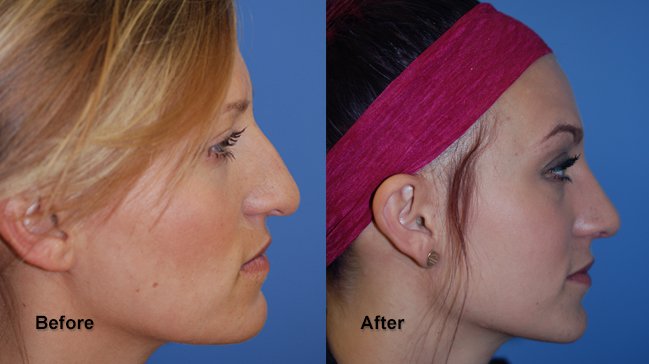 jones rhinoplasty 8