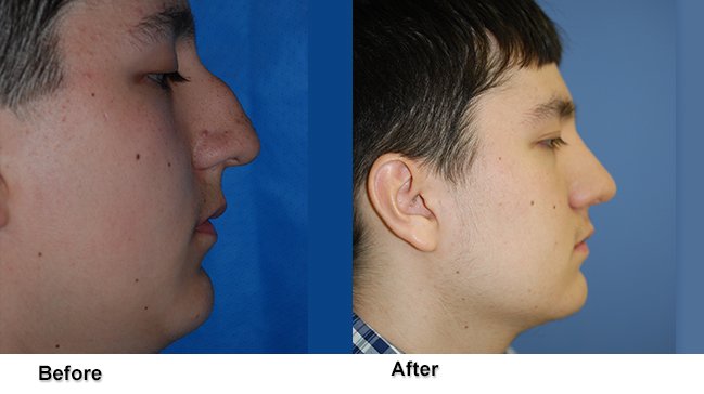 Dr. Jones Before and After Rhinoplasty