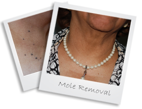 mole 14