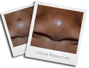 moleremoval