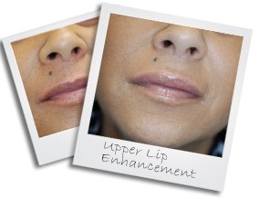 lip small1