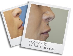 lip small2