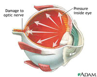 glaucoma_lowres