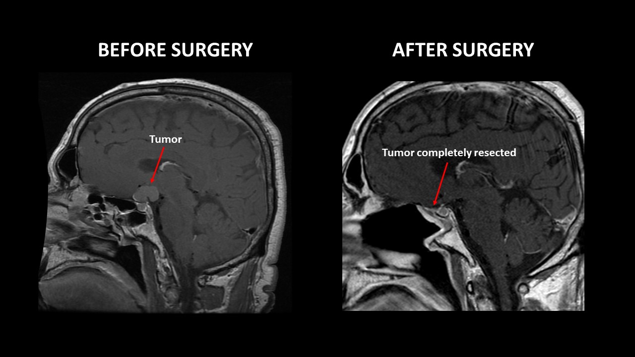 Skull base MRI before and after surgery