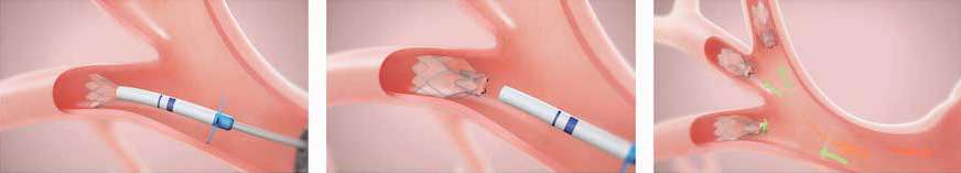 medical illustrations of Zephyr® Endobronchial Valve procedure