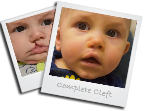 Complete Cleft