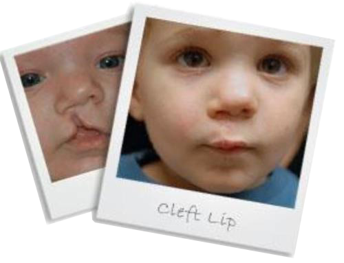 newcleftlipsmall
