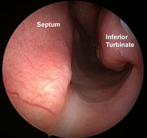 nasal cavity after inferior turbinate reduction