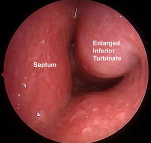 nasal cavity with severe nasal obstruction