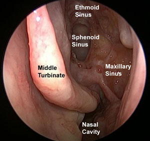 sinus cavities after polyp removal