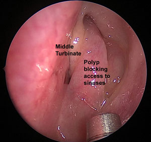 sinus cavities with polyp