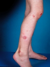 nummular eczema legs1 TAS