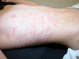 pityriasis rosea TAS