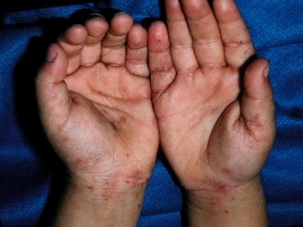 SCABIES WRISTS TAS