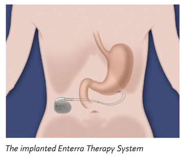 Enterra implant