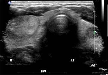 thyroid nodule