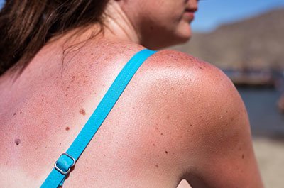 sunburn