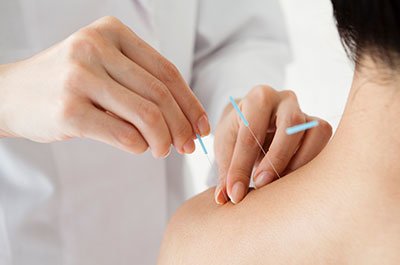 acupuncture for anxiety