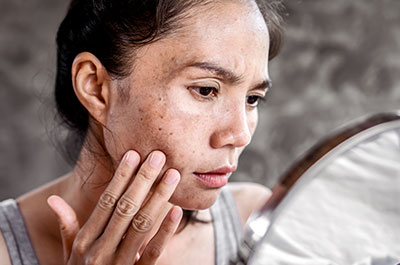 hyperpigmentation