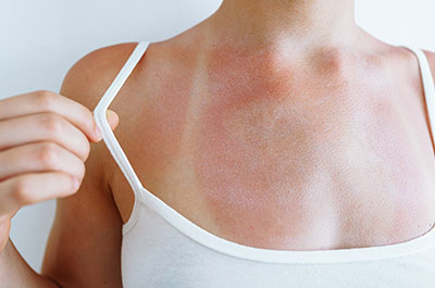 sun sensitivity