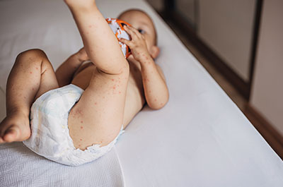 hand food mouth disease