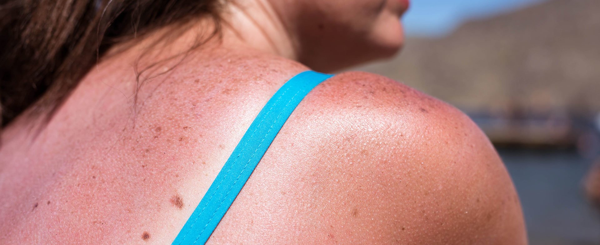 How to Heal A Sunburn (No blisters, No Pain and No peeling) and