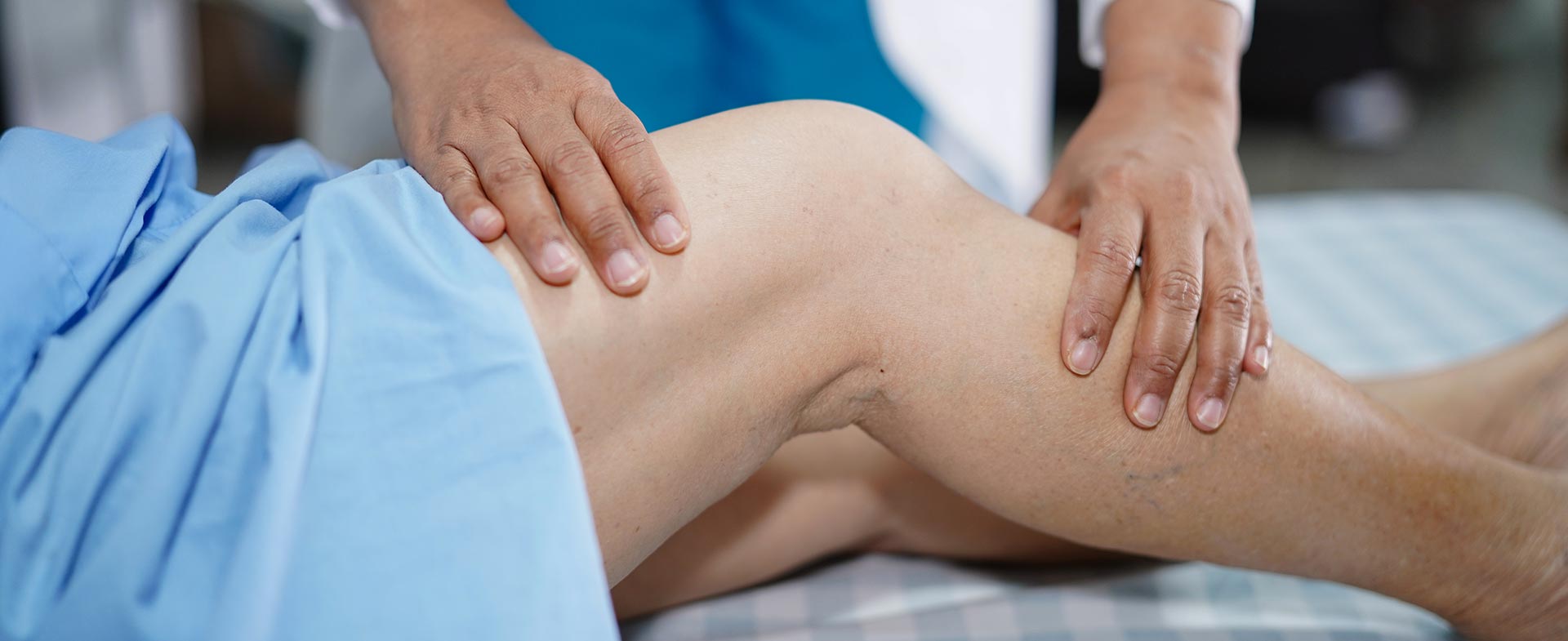 varicose veins