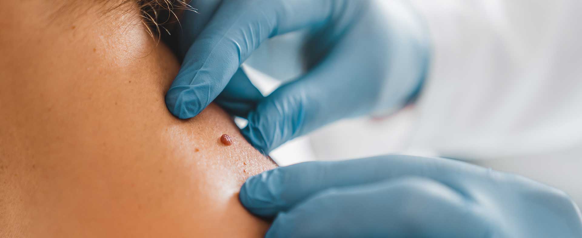 How To Prep For A Full Body Skin Cancer Exam