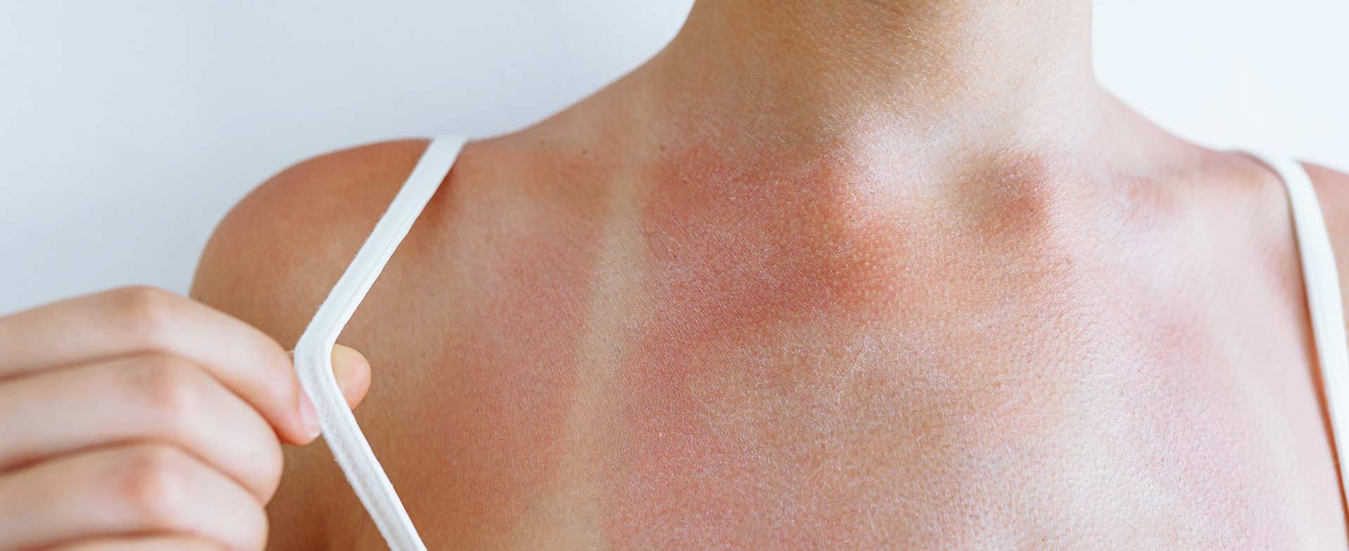 sun sensitivity