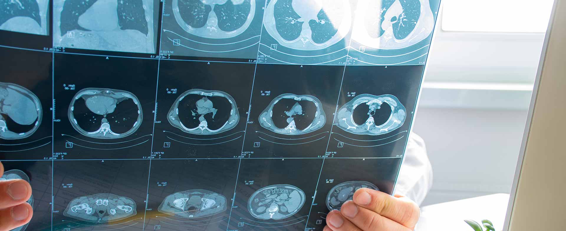 lung cancer screening