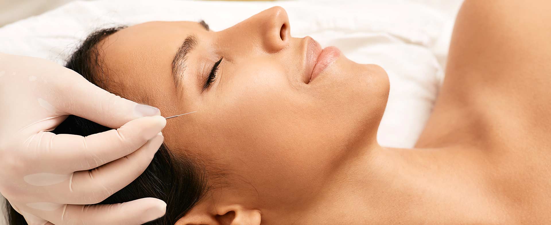 A person receiving facial acupuncture, lying on a treatment table with closed eyes. A gloved hand is carefully placing a thin needle on the person's cheekbone. cosmetic acupuncture