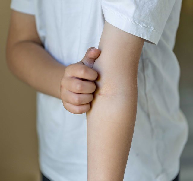 child itching eczema