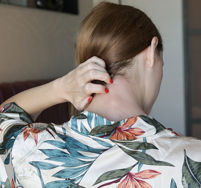 Shingles Rash On Neck Shingles rash on neck