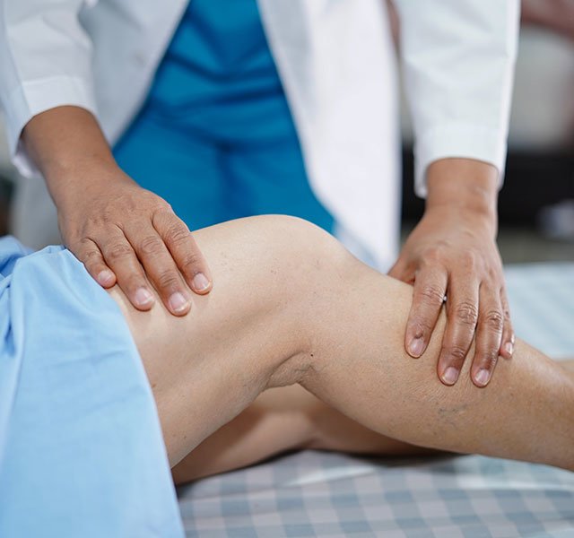 varicose veins